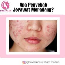 Apa Penyebab Jerawat Meradang Meskipun Beberapa Ahli Belum Mengetahuinya Secara Pasti Beberapa Faktor Berikut Dapa Skin Care Rodan And Fields Acne Bacteria