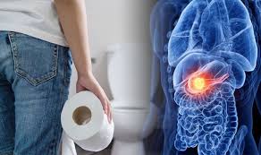 The pancreas is a long, flat organ located behind the stomach. Pancreatic Cancer Symptoms Light Coloured Poo And Dark Coloured Urine Could Be Signs Express Co Uk