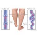 When is varicose vein removal deemed a cosmetic treatment? Varicose Veins Cigna