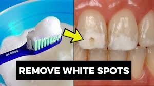 There are several main causes of white spots on the teeth including enamel hypoplasia, fluorosis as well as spots occurring after the removal of. How To Get Rid Of White Spots On Teeth Best Ways To Get Rid Of White Spots On Teeth Youtube