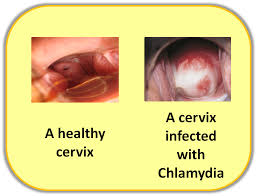Citeste totul despre hpv (human papilloma virus) pe sfaturimedicale.ro ✅ afla cele mai noi tratament hpv barbati. Chlamydia Aras Asociatia Romana Anti Sida