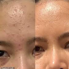 Us recommended dietary allowance (rda): Student Reveals The Diet And Skincare Regime That Cleared Up Her Embarrassing Acne Using Js Health Newsopener