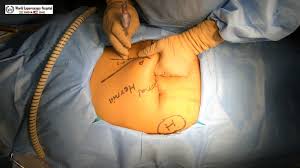 Palmer described the use of the left subcostal pararectus region as the primary puncture site, known as palmer's point (figure 1).(4) this technique has mainly been Laparoscopic Palmer S Access Technique