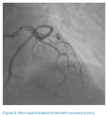 Life | Free Full-Text | Cardiac Imaging In Women With Ischemic Heart Disease