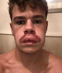 Homem Pinta O Bigode Para O Tornar Mais Escuro E Descobre Que E Alergico A Tinta