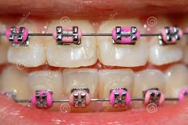 Cute Pink Braces Teeth Braces Ideas Aparelho Dental Dentes Aparelho