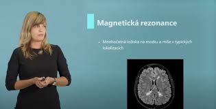 Více informací o diagnostice a léčbě rs: Video Roztrousena Skleroza A Jeji Prubeh V Case Prosestru Cz