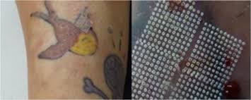 I wake myself up itching during the night. Ablative Laser Surgery For Allergic Tattoo Reactions A Retrospective Study Springerlink