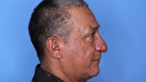 New York painter with rare deformity gets new nose for Christmas