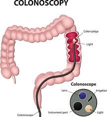 Jun 25, 2020 · what is a colon cleanse? Colon Cancer The Evolution Of Colonoscopy Intercoastal Medical Group