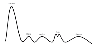 Multiple myeloma is a cancer that begins in plasma cells, a type of white blood cell. Understanding And Interpreting The Serum Protein Electrophoresis American Family Physician