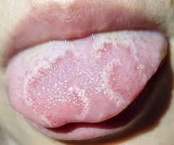 Image result for Puchýře na jazyku