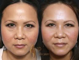 Looking Tired Consider Under Eye Bag Surgery Lower Blepharoplasty For A Rejuvenated Look Dr Andrew K Ch Eye Bag Surgery Plastic Surgery Eyelid Surgery