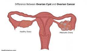 Why should i choose memorial sloan kettering for ovarian cancer ovarian cancer is a disease in which cells in the ovaries multiply and grow abnormally. Ovarian Cancer Misdiagnosed As Cyst Ovarian Cancer Vs Cyst