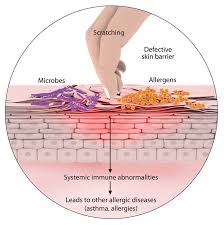 Image result for Atopic eczema atopic dermatitis