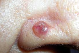 Image result for skin cancer on nose pimple