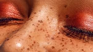 Image result for Freckled skin