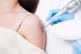 Depending on the size of the tattoo, surgical removal may range between $150 and $350, according to st. Laser Tattoo Removal An Increasing Client Request