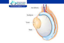 Testicular Cancer Testicular Cancer Pictures Testicular Cancer Treatment
