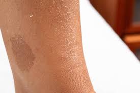 Image result for liver spots on legs