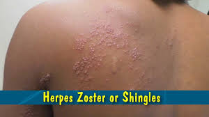 And who needs the shingles vaccine? Herpes Zoster Or Shingles Youtube