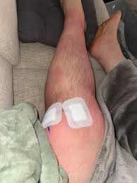 2 days post op partial lateral menisectomy, I thought it was a full removal  but partial, feel really good, can put my foot down and can walk without  crutches, had spinal injection