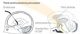 Endoscopic Third Ventriculostomy Spinal Fluid Stenosis Third