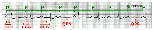 We did not find results for: Atrioventricular Block Knowledge Amboss