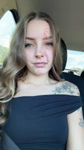 What Is Taiyamichelle Scar