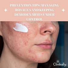 Image result for demodex rosacea