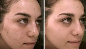 Pin On Acne Scars On Face