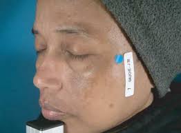 A double-blind controlled study of a nonhydroquinone bleaching cream in the  treatment of melasma