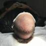 hair transplant in islamabad from www.royalcosmeticsurgery.com.pk
