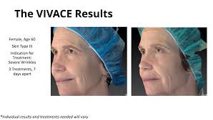 Vivace Microneedling Hartford County