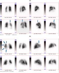 Image result for Ventilation Perfusion Scan