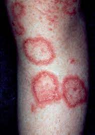 Lupus Erythematodes Hat Viele Gesichter Springerlink