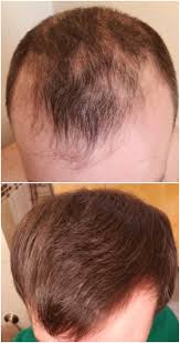 The Most Effective Hair Growth Shampoos Conditioner In 2020 Hair Restoration Hair Growth Formula Natural Hair Regrowth Remedies