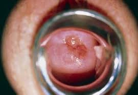 Ovarian cancer is particularly difficult to treat, because it is frequently diagnosed late in the course of. Cervical Cancer Gynecology And Obstetrics Msd Manual Professional Edition