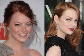 Emma Stone Plastic Surgery Before After Nose Job Pics