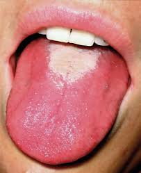 Image result for brown tongue symptoms