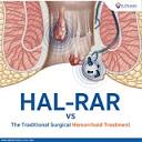 The Difference between HAL-RAR and the Traditional Surgical Hemorrhoid