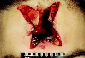 Your exam today did not show injury to any deep organs or tissues. Gunshot Wound Deaths Springerlink