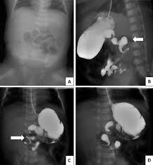Image result for Midgut Volvulus