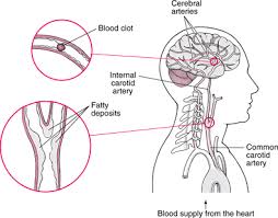 Suspect a blocked artery in the kidney if you experience: Ischemic Stroke Brain Spinal Cord And Nerve Disorders Msd Manual Consumer Version