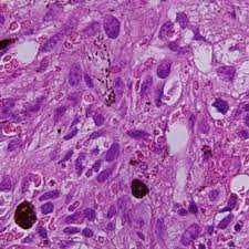 Pdf Metastatic Malignant Melanoma In Bone Marrow With Occult Primary Site A Case Report With Review Of Literature