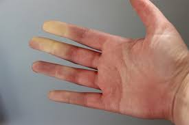 Amorteala degete si durere maini de la inceputul acestui an am avut niste dureri in urma cu cateva zile a inceput sa imi amorteasca capul si obrazul stang iar ieridupa ce am facut niste exercitii fizice a inceput sa imi tremure mana stanga nu o. Sindromul Raynaud Cauze Simptome Tratament Preventie Reginamaria Ro