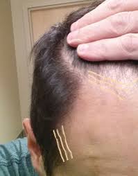 At the shanghai university of traditional chinese medicine determined that administering acupuncture with the qi xing (seven star) needle increases the rate of positive patient outcomes. How I Stopped Hair Loss And Regrew Hair For 20 Years Updated 2020