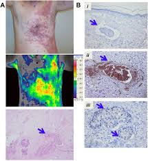 Inflammatory breast cancer symptoms usually start quickly. Inflammatory Breast Cancer Tumor Emboli Express High Levels Of Anti Apoptotic Proteins Use Of A Quantitative High Content And High Throughput 3d Ibc Spheroid Assay To Identify Targeting Strategies Abstract Europe Pmc