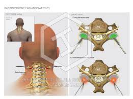 Image result for Radiofrequency Surgery