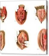 Image result for chancroid